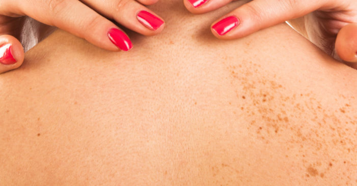 The Skin Cancer Foundation Shares Sun Protection Tips for Tropical Holiday Vacations