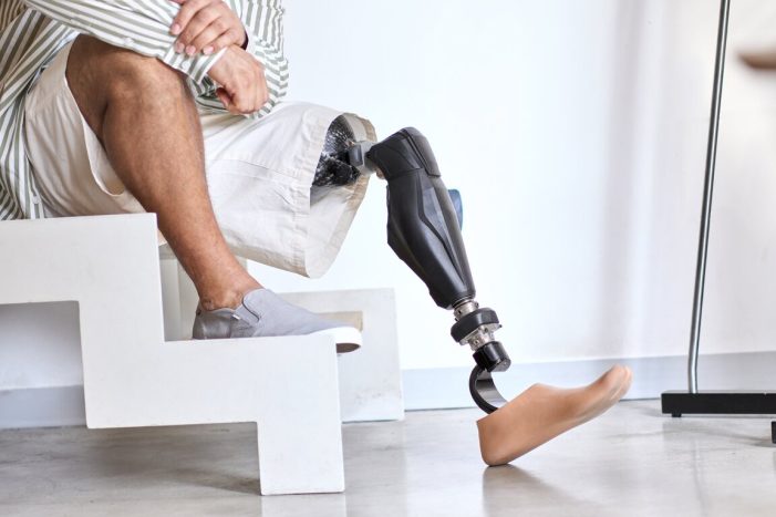 Dealing with Amputation After an Accident: What You Need to Know from a Legal Perspective