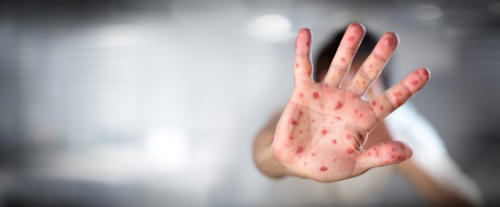Hand, Foot and Mouth Disease: What Is It? Symptoms, Risk Factors, Contagiousness—and Why It’s on the Rise in New York